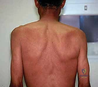 التشريح الدقيق لمسار العصب فوق الكتفي