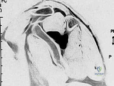 تأثير الكيسات العقدية والضغط الميكانيكي على العصب