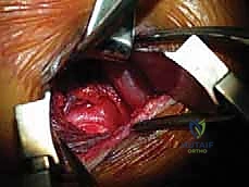 تحديد مسار العصب والخيارات العلاجية