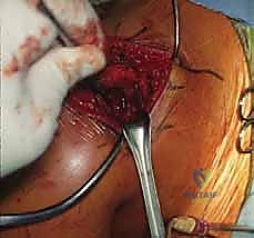 صورة رنين مغناطيسي توضح كيسة عقدية تضغط على العصب