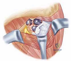 صورة توضيحية لـ تحرير العصب فوق الكتفي: علاج متقدم لآلام الكتف وضعفه مع الأستاذ الدكتور محمد هطيف في صنعاء