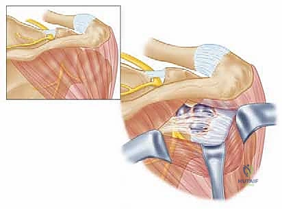 صورة توضيحية لـ تحرير العصب فوق الكتفي: علاج متقدم لآلام الكتف وضعفه مع الأستاذ الدكتور محمد هطيف في صنعاء