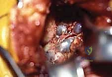 صورة توضيحية لـ تحرير العصب فوق الكتفي: علاج متقدم لآلام الكتف وضعفه مع الأستاذ الدكتور محمد هطيف في صنعاء