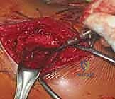 صورة طبية: تحرير العصب فوق الكتفي: علاج متقدم لآلام الكتف وضعفه مع الأستاذ الدكتور محمد هطيف في صنعاء