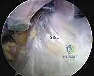 صورة توضيحية لـ تحرير العصب فوق الكتفي: علاج متقدم لآلام الكتف وضعفه مع الأستاذ الدكتور محمد هطيف في صنعاء