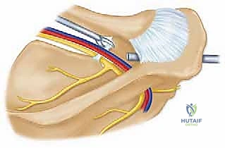 صورة توضيحية لـ تحرير العصب فوق الكتفي: علاج متقدم لآلام الكتف وضعفه مع الأستاذ الدكتور محمد هطيف في صنعاء