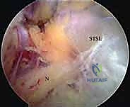 صورة توضيحية لـ تحرير العصب فوق الكتفي: علاج متقدم لآلام الكتف وضعفه مع الأستاذ الدكتور محمد هطيف في صنعاء