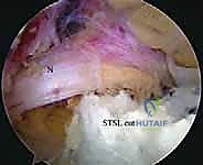 Suprascapular Nerve Decompression: An Intraoperative Masterclass