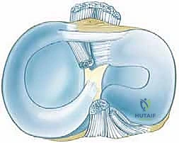 استئصال الغضروف الهلالي بالمنظار: دليل شامل لعلاج تمزقات الركبة مع الأستاذ الدكتور محمد هطيف