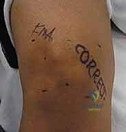 إنشاء المداخل الجراحية الدقيقة بالمنظار