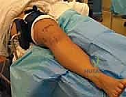 صورة توضيحية لـ استئصال الغضروف الهلالي بالمنظار: دليل شامل لعلاج تمزقات الركبة مع الأستاذ الدكتور محمد هطيف