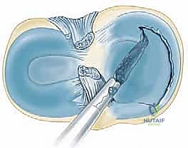 تنعيم حواف الغضروف باستخدام الشيفر الجراحي
