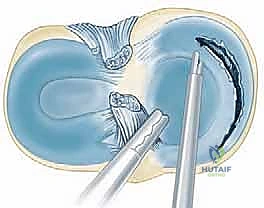 استخدام الأدوات الدقيقة لاستئصال الجزء الممزق