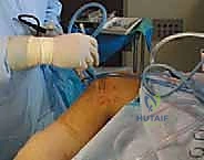 صورة توضيحية لـ استئصال الغضروف الهلالي بالمنظار: دليل شامل لعلاج تمزقات الركبة مع الأستاذ الدكتور محمد هطيف