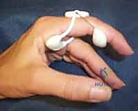 Surgical technique step for Open Reduction and Internal Fixation of Phalangeal Condylar Fractures