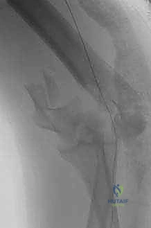 التصوير الإشعاعي لكسر الكوع