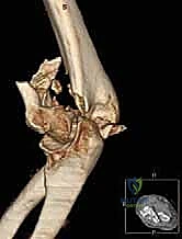 كشف المفصل الجراحي