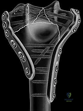 إعادة تجميع قطع العظم