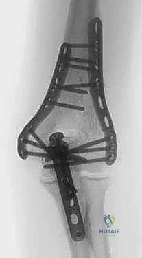 صورة توضيحية لـ كسر عظم العضد البعيد التثبيت الداخلي المفتوح (ORIF): دليل شامل لاستعادة وظيفة الكوع مع الأستاذ الدكتور محمد هطيف