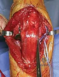 التعامل مع العصب الزندي