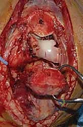 تقييم كسر عظم العضد البعيد