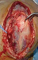 صورة توضيحية لـ كسر عظم العضد البعيد التثبيت الداخلي المفتوح