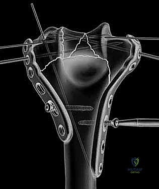 إصلاح العظم والإغلاق