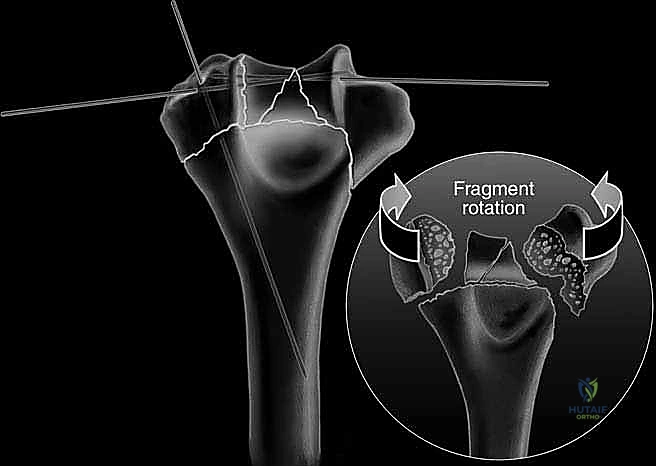 التثبيت بالصفائح والمسامير