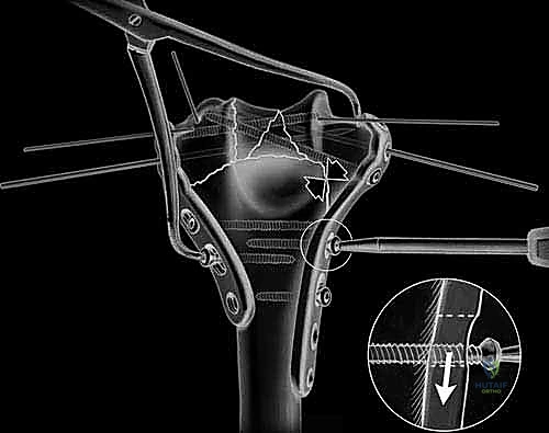 صورة توضيحية لـ كسر عظم العضد البعيد التثبيت الداخلي المفتوح (ORIF): دليل شامل لاستعادة وظيفة الكوع مع الأستاذ الدكتور محمد هطيف