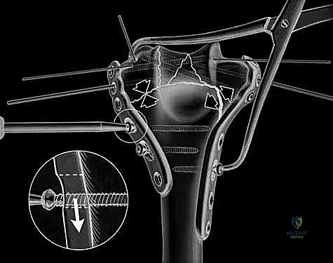 كسر عظم العضد البعيد التثبيت الداخلي المفتوح (ORIF): دليل شامل لاستعادة وظيفة الكوع مع الأستاذ الدكتور محمد هطيف
