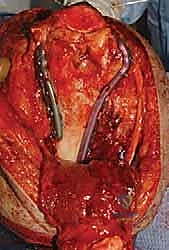 صورة توضيحية لـ كسر عظم العضد البعيد التثبيت الداخلي المفتوح (ORIF): دليل شامل لاستعادة وظيفة الكوع مع الأستاذ الدكتور محمد هطيف