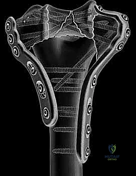 صورة توضيحية لـ كسر عظم العضد البعيد التثبيت الداخلي المفتوح (ORIF): دليل شامل لاستعادة وظيفة الكوع مع الأستاذ الدكتور محمد هطيف