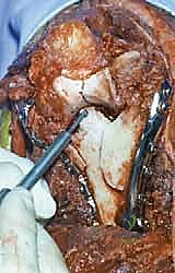 Mastering Distal Humerus ORIF: An Intraoperative Guide to Supracondylar and Intercondylar Fractures