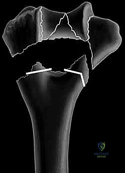 صورة توضيحية لـ كسر عظم العضد البعيد التثبيت الداخلي المفتوح (ORIF): دليل شامل لاستعادة وظيفة الكوع مع الأستاذ الدكتور محمد هطيف