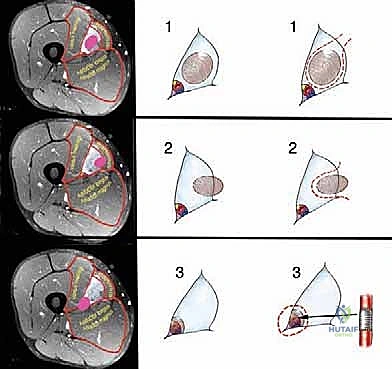 Illustration of overview of surgical - Dr. Mohammed Hutaif