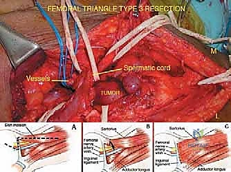 ساركوما الأنسجة الرخوة خارج الحجرات في الطرف السفلي: دليل شامل للتشخيص والعلاج المتقدم