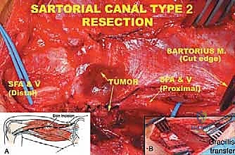 التشخيص الإشعاعي والرنين المغناطيسي لساركوما الأطراف