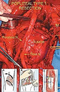 صورة توضيحية لـ ساركوما الأنسجة الرخوة خارج الحجرات في الطرف السفلي: دليل شامل للتشخيص والعلاج المتقدم