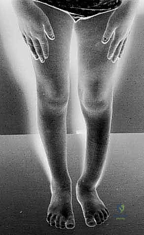 Masterclass: Williams Rod Fixation for Congenital Tibial Pseudarthrosis