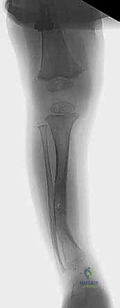 تشريح قصبة الساق المصابة بالالتحام الكاذب