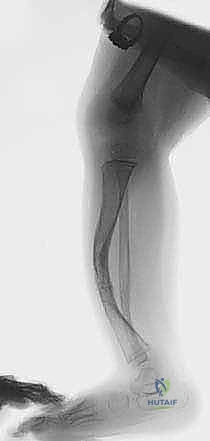 تفاصيل القناة النخاعية والتشوه العظمي