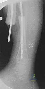 تصميم قضيب ويليامز داخل النخاع