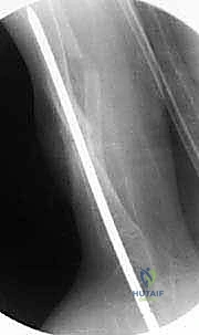 التعامل مع عظمة الشظية