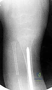 وضع الطعوم العظمية لتحفيز الالتئام