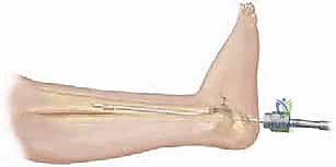 تجهيز القناة النخاعية