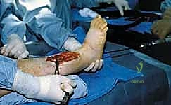 استئصال النسيج العابي الليفي