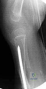 إدخال قضيب ويليامز في قصبة الساق