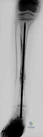 إغلاق الجرح ووضع الجبس