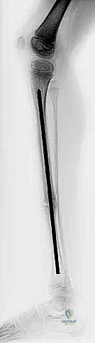 صورة توضيحية لـ علاج الالتحام الكاذب الخلقي في قصبة الساق بقضيب ويليامز: دليل شامل للمرضى