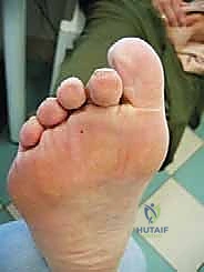 صورة توضيحية لـ عملية وايل لتصحيح قصر مشط القدم: دليل شامل لعلاج آلام مقدمة القدم وخلع المفاصل